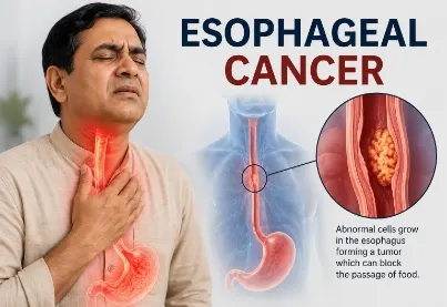 Esophageal Cancer Care